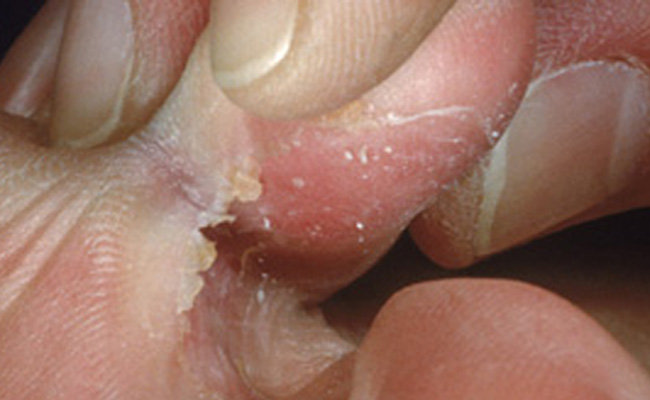 skin splitting between toes #11