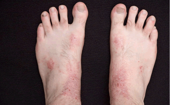 Skin Conditions - Foot Health Podiatry | Foot Health Podiatry