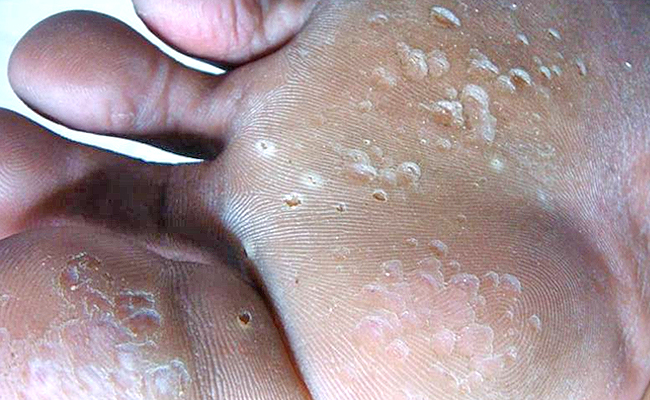 skin diseases on feet